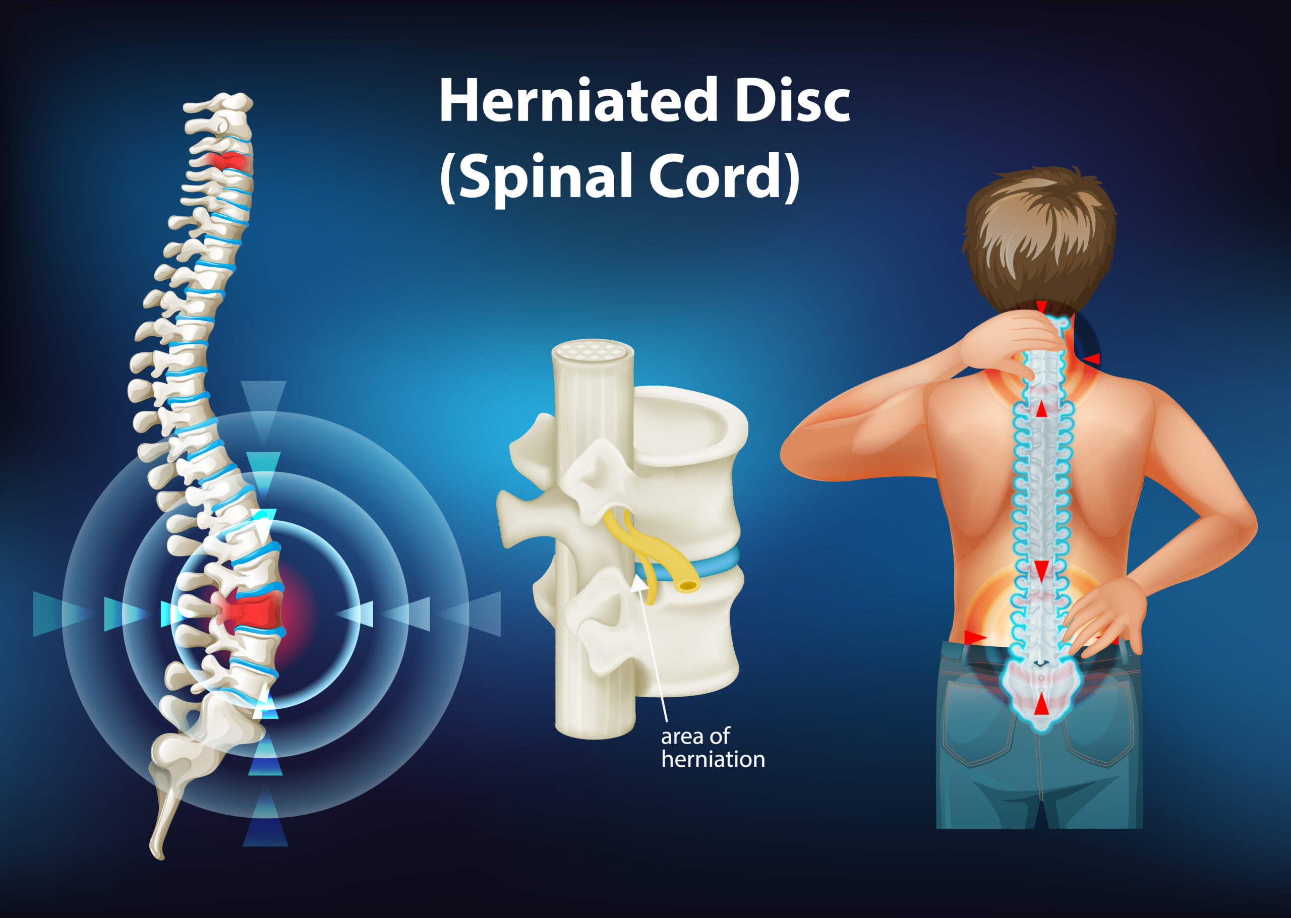 chiropractor herniated disc frisco
